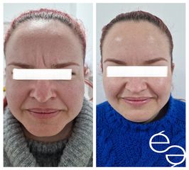 Eliminación de arrugas - Clinica Ésmèdic