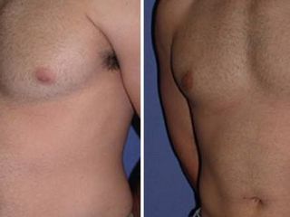 Antes y despues de ginecomastia