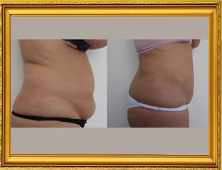 Antes y después abdominoplastia