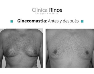 Ginecomastia - Clínica Rinos