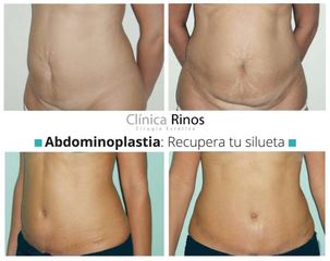 Abdominoplastia - Clínica Rinos