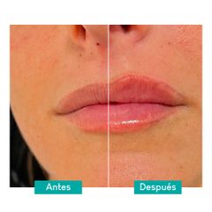 Aumento de labios - Clínica Rinos