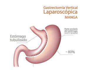 Gastrectomía vertical laparoscópica o manga gástrica