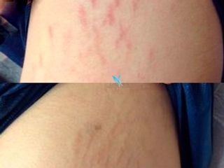 Antes y después ¡Dermapen sesiones Estrías