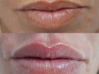 Aumento labios - 629972