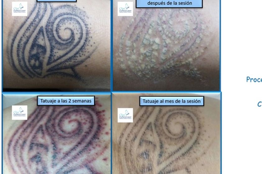 Eliminación de tatuajes antes y después - 493524