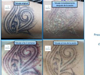 Antes y después Eliminación de Tatuajes