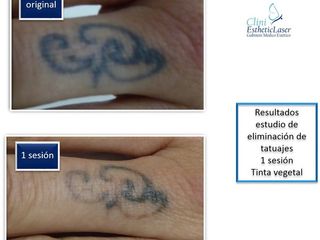 Antes y después Eliminación de Tatuajes