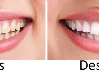 Antes y despues de blanquemiento dental