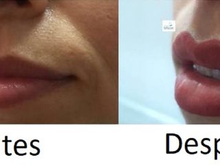 Antes y despues de micropigmentacion de labios o perfilado