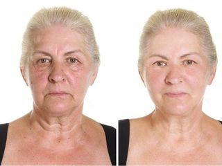 Antes y despues de rejuvenecimiento facial