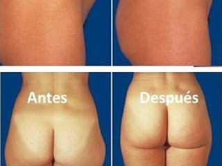 Antes y despues de lipoescultura