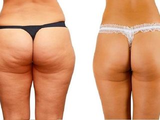 Antes y despues de lipoescultura