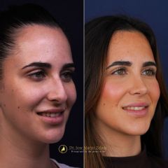 Clínica Lessence - Rinoplastia