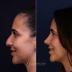 Clínica Lessence - Rinoplastia