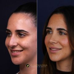 Clínica Lessence - Rinoplastia