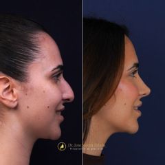 Clínica Lessence - Rinoplastia
