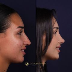 Clínica Lessence - Rinoplastia