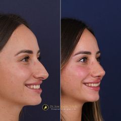 Clínica Lessence - Rinoplastia