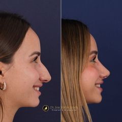 Clínica Lessence - Rinoplastia