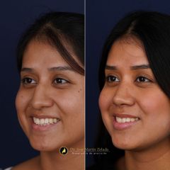 Clínica Lessence - Rinoplastia