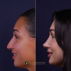 Clínica Lessence - Rinoplastia
