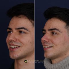 Clínica Lessence - Rinoplastia