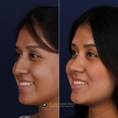 Clínica Lessence - Rinoplastia