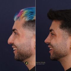 Clínica Lessence - Rinoplastia