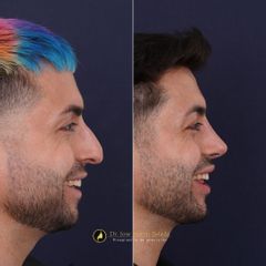 Clínica Lessence - Rinoplastia