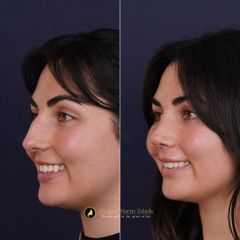 Clínica Lessence - Rinoplastia