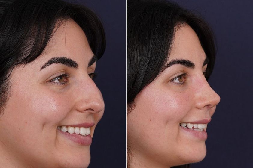 Rinoplastia antes y después - 881525