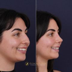 Clínica Lessence - Rinoplastia