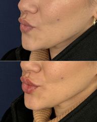 Clínica Lessence - Aumento de labios