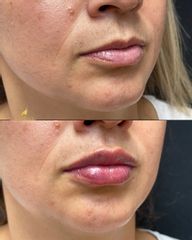 Clínica Lessence - Aumento de labios
