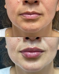 Clínica Lessence - Aumento de labios de frente