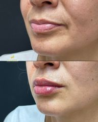 Clínica Lessence - Aumento de labios