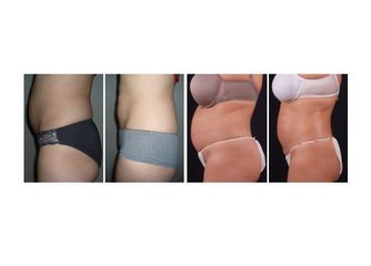 Antes y después Abdominoplastia