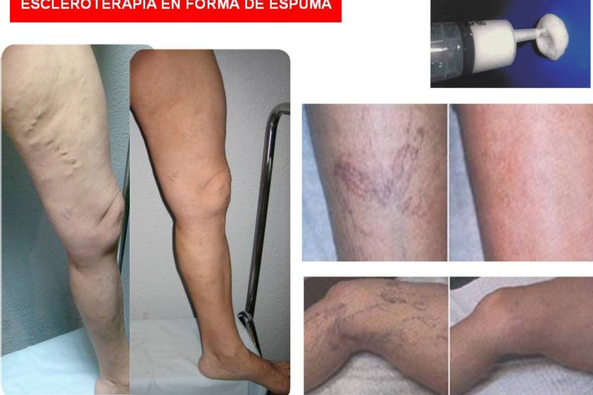Tratamiento varices antes y después - 294078