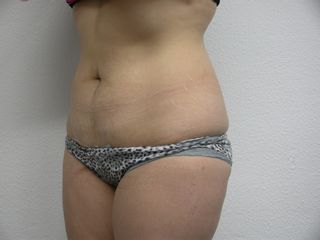 Lipoescultura antes 45º