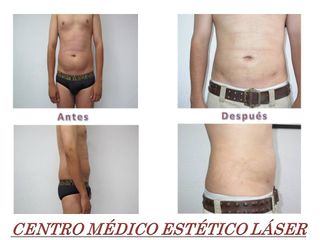 Antes y después Lipoescultura en un paciente hombre