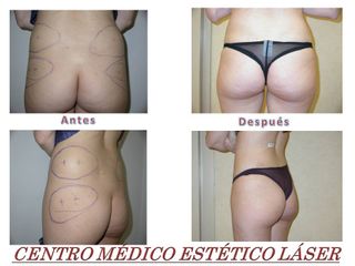 Antes y después Lipofillling en glúteos