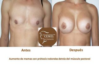 Antes y después Aumento mamas