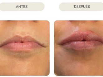 Aumento labios antes y después - 874330