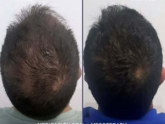Mesoterapia antes y después - 874331