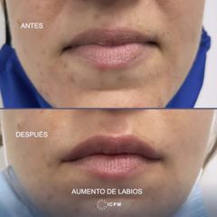 aumento de labios