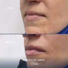 Aumento de labios
