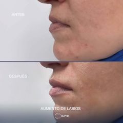 Aumento de labios