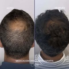 MESOTERAPIA CAPILAR Y TRATAMIENTO ORAL