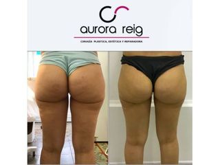 Celulitis - Aurora Reig